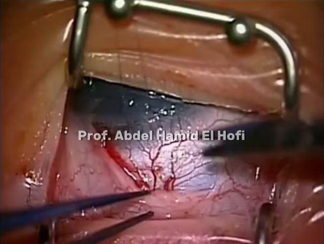 Deep Ssclerectomy Trabeculotomy In Congenital Glaucoma