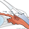 Glaucoma surgeries