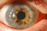 Keratoplasty surgeries