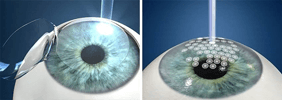 Refractive surgeries and management of post refractive surgeries complications